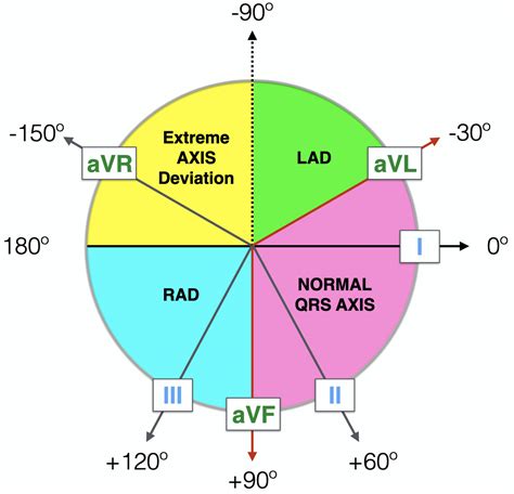 lv v v rh|lvh left axis deviation.